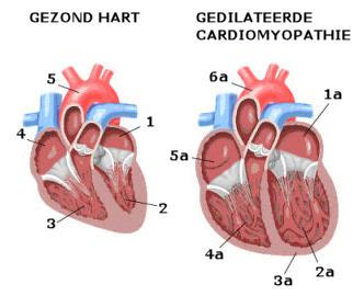 gedilateerde lv|Gedilateerde cardiomyopathie: symptomen, oorzaken, tests en.